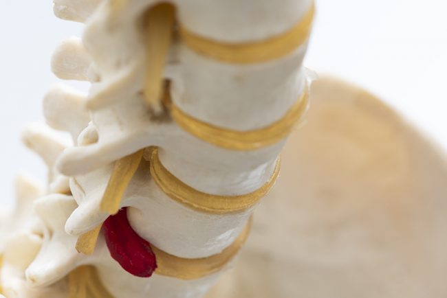 Close-up view of herniated lumbar disc model