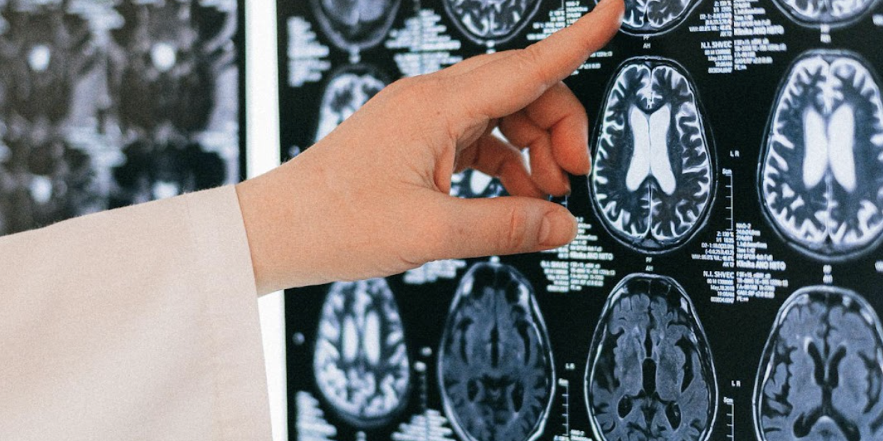 Chiari Malformation Chiari Malformation