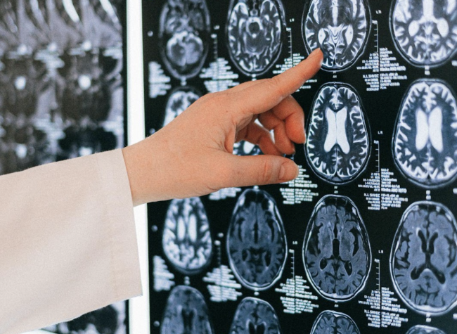 Chiari Malformation Chiari Malformation