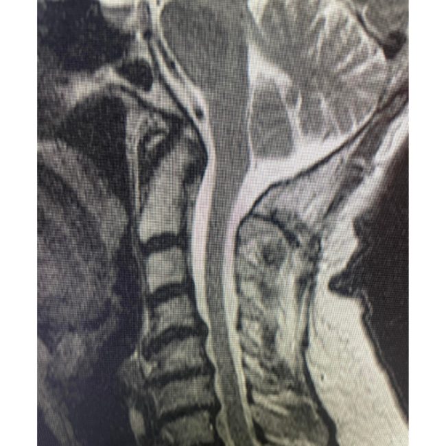 Chiari Decompression