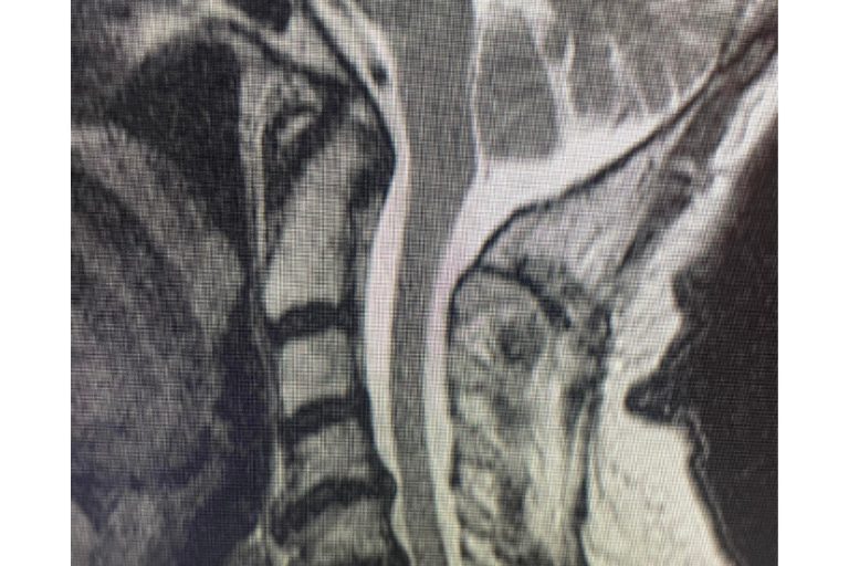 Chiari Decompression