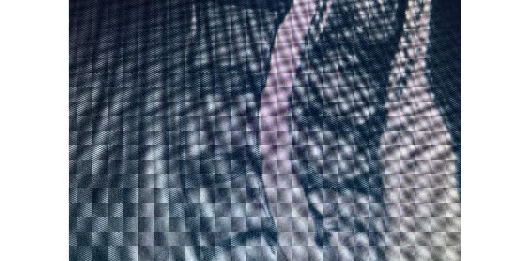 ALIF with Posterior Stabilization: Restoring Function After Chronic L5–S1 Disc Collapse ALIF with Posterior Stabilization: Restoring Function After Chronic L5–S1 Disc Collapse