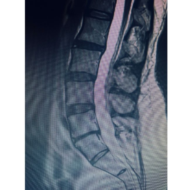 ALIF with Posterior Stabilization: Restoring Function After Chronic L5–S1 Disc Collapse