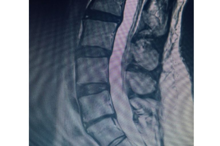 ALIF with Posterior Stabilization: Restoring Function After Chronic L5–S1 Disc Collapse
