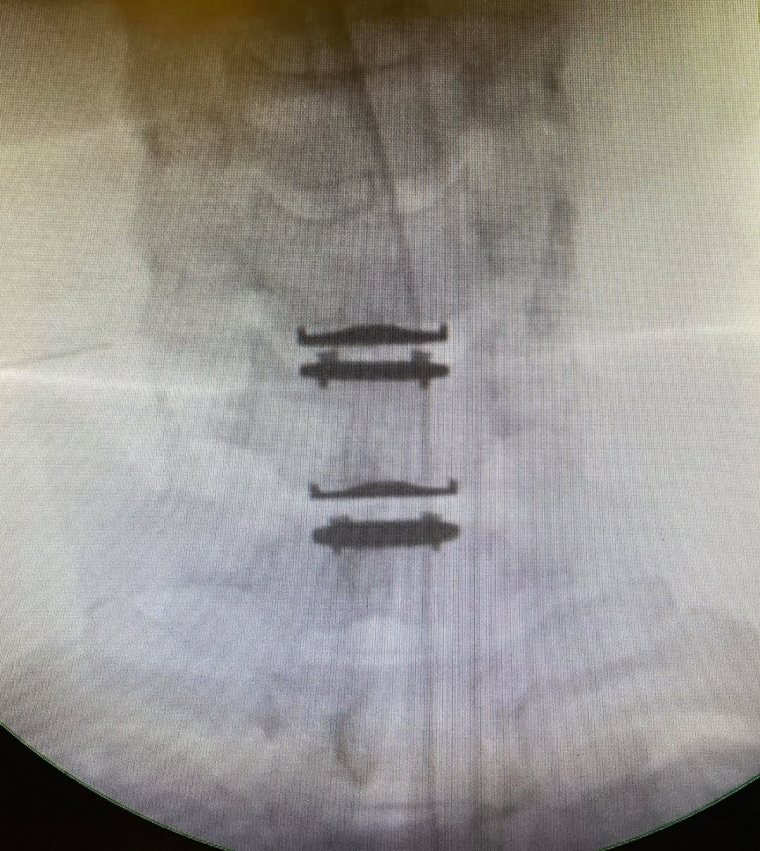 Two Level Disc Replacement Two-Level Cervical Disc Replacement: Is Disc Arthroplasty the Right ...